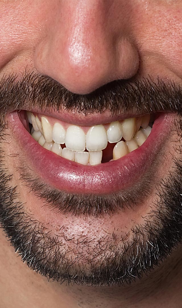 Geans Clinic - Gaps - Lost Teeth Concern Details