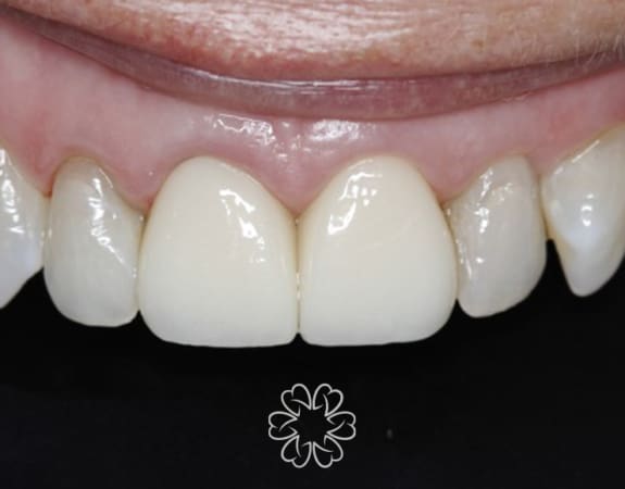 Geans Clinic - Gum Lift Patient After