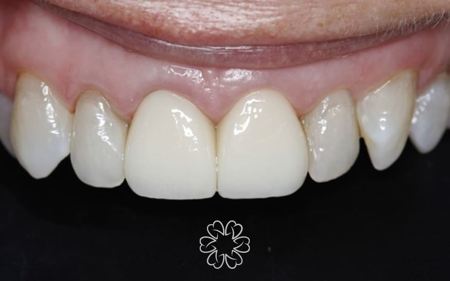 Geans Clinic - Gum Lift Patient After