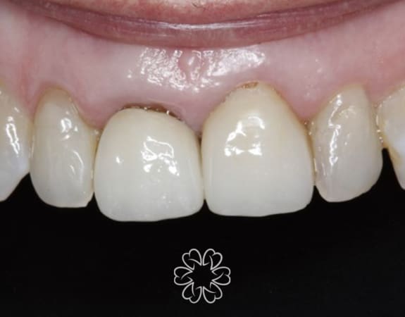 Geans Clinic - Gum Lift Patient Before