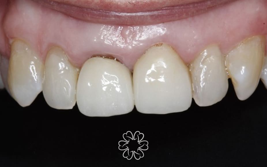 Geans Clinic - Gum Lift Patient Before