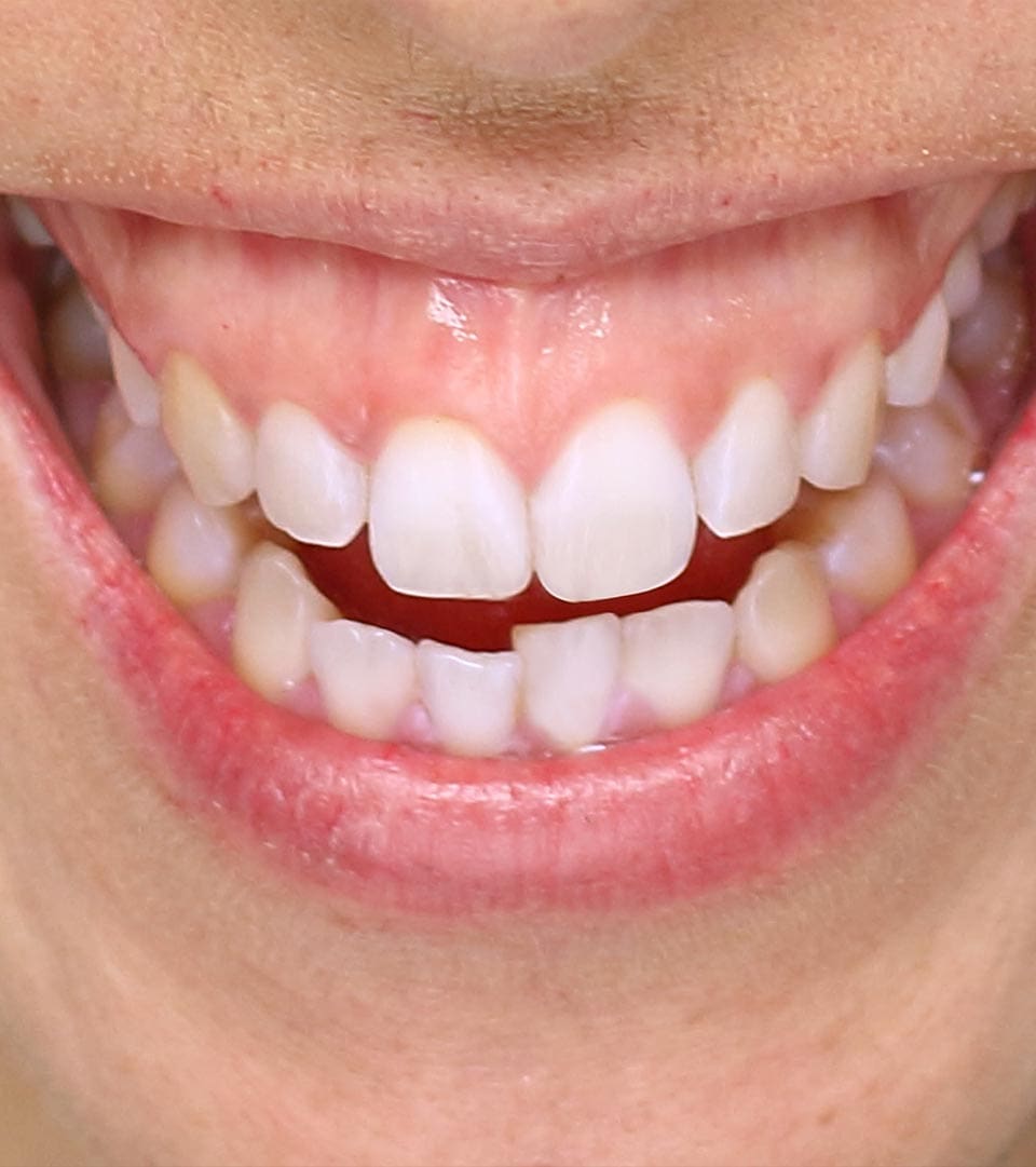 Geans Clinic - Gummy Smile