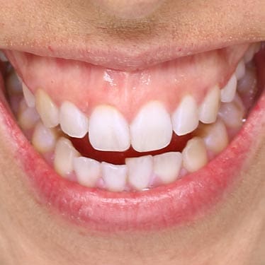 Geans Clinic - Gummy Smile