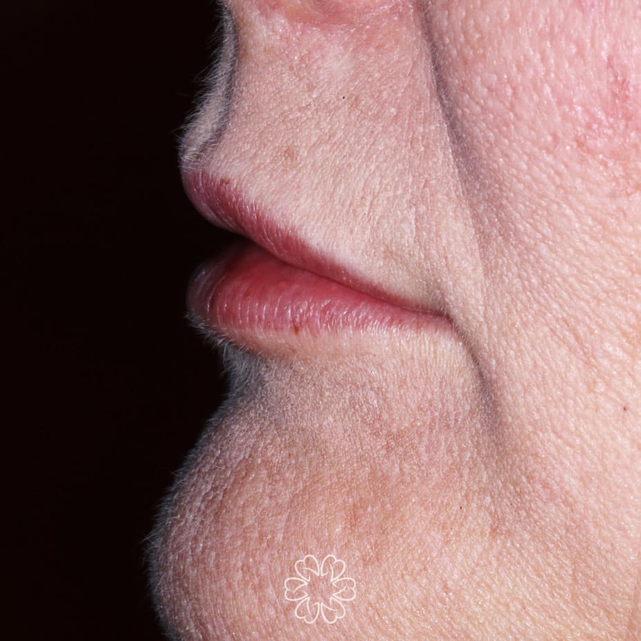 Geans Clinic - Lip Filler Patient After