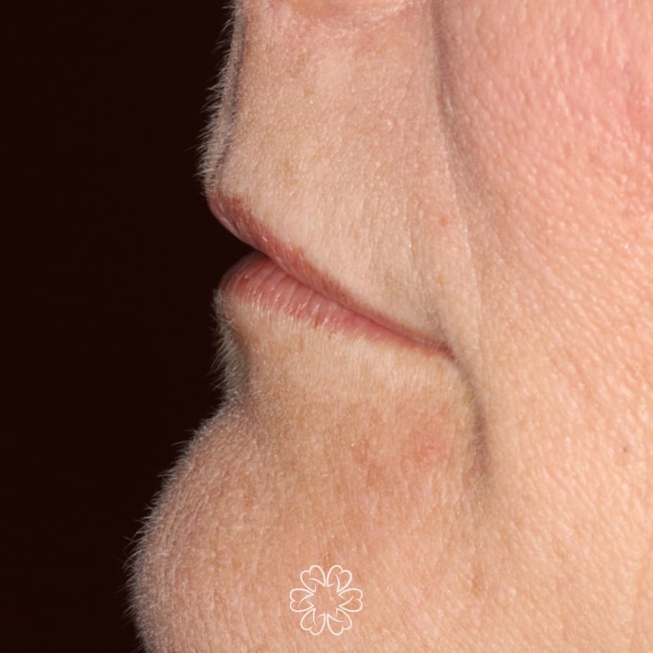 Geans Clinic - Lip Filler Patient Before