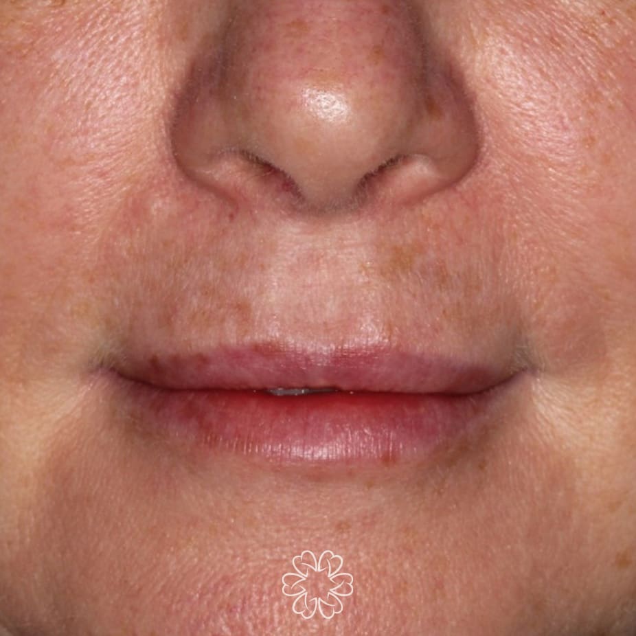 Geans Clinic - Lower Face Rejuvenation Patient After