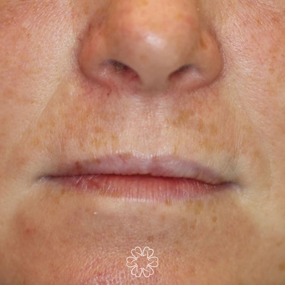 Geans Clinic - Lower Face Rejuvenation Patient Before