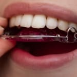 Geans Clinic - Orthodontic Retainers
