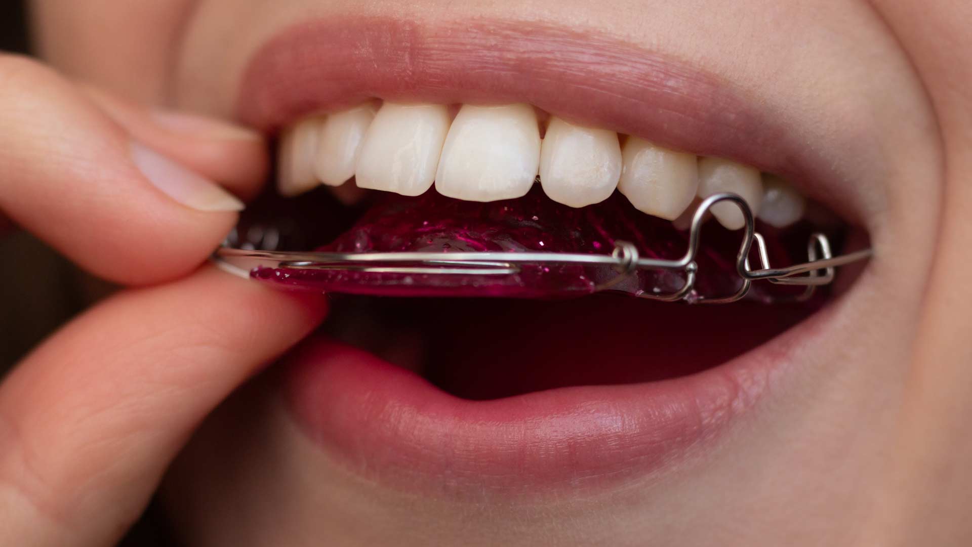 Geans Clinic - Orthodontic Retainers