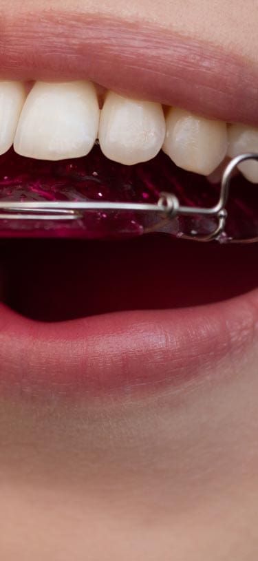 Geans Clinic - Orthodontic Retainers