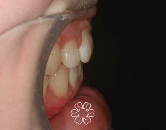Geans Clinic - Orthodontics Patient After