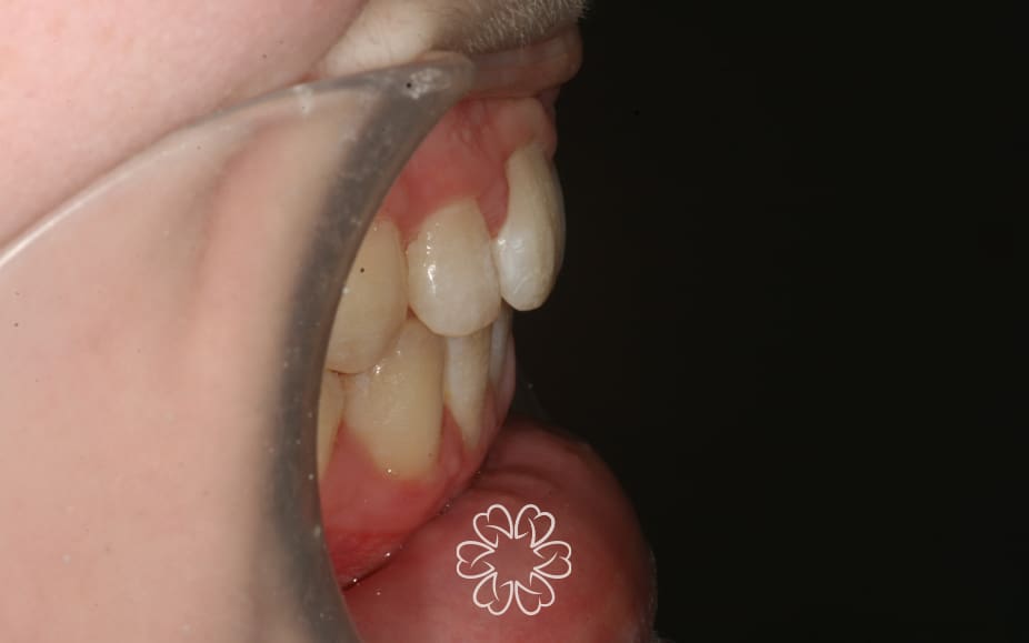 Geans Clinic - Orthodontics Patient After