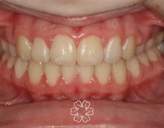Geans Clinic - Orthodontics Patient After