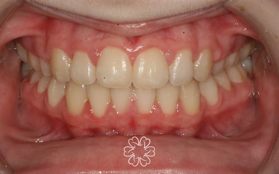 Geans Clinic - Orthodontics Patient After