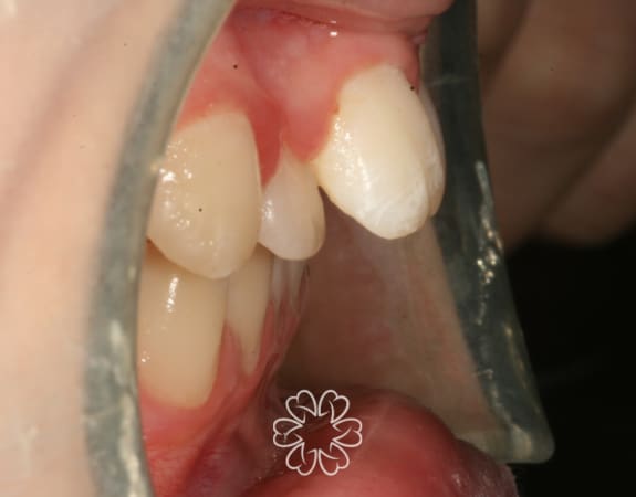 Geans Clinic - Orthodontics Patient Before