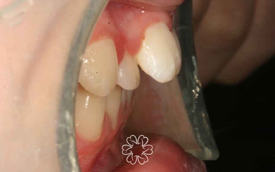 Geans Clinic - Orthodontics Patient Before