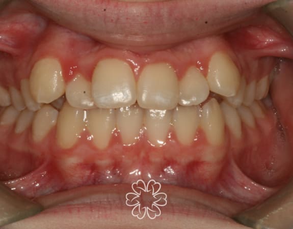 Geans Clinic - Orthodontics Patients Before