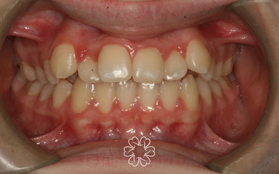 Geans Clinic - Orthodontics Patients Before