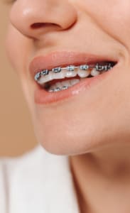 Geans Clinic - Orthodontics Price List