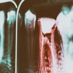 Geans Clinic - Root Canal Treatment