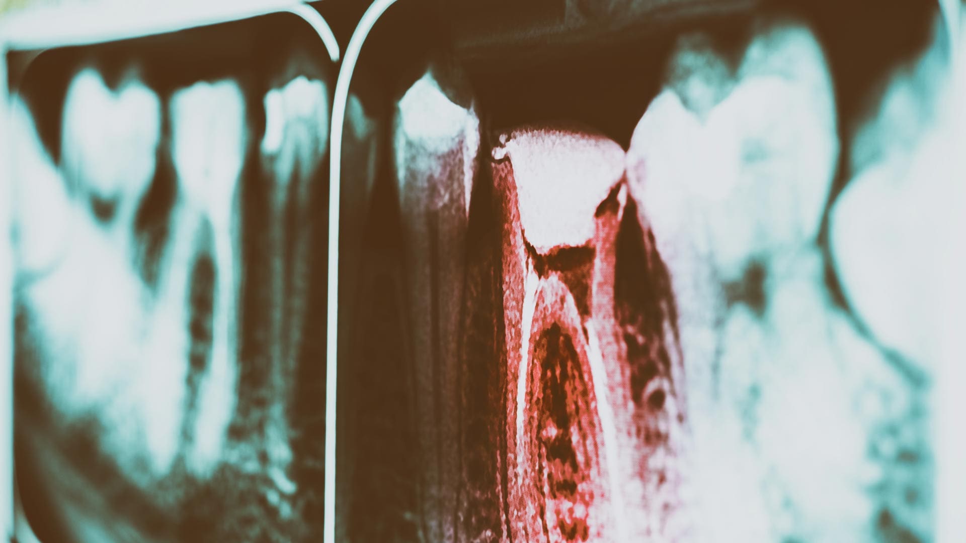 Geans Clinic - Root Canal Treatment