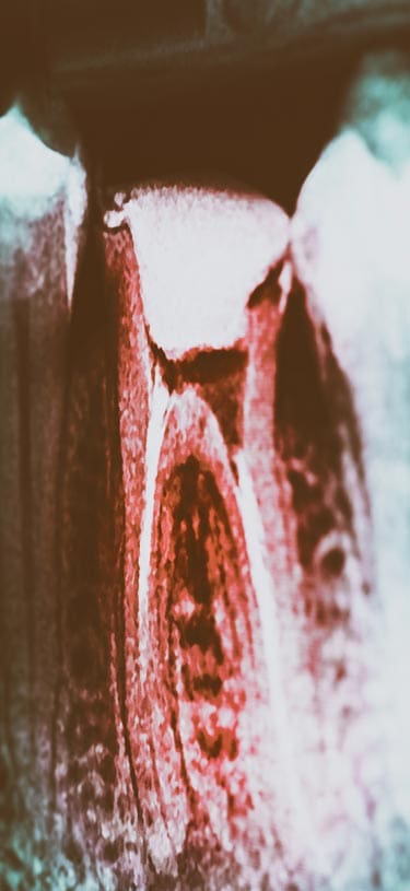 Geans Clinic - Root Canal Treatment