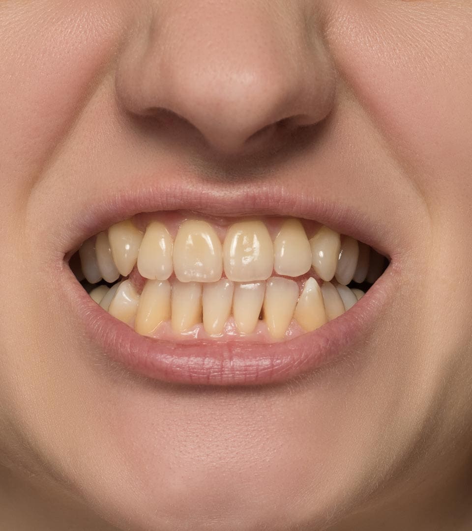 Geans Clinic - Tooth Discolouration