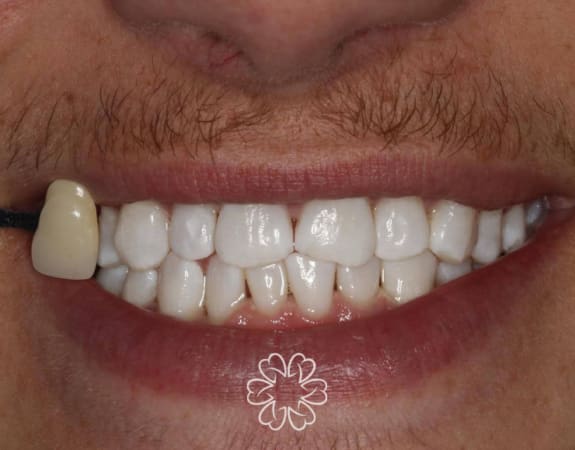 Geans Clinic - Tooth Whitening Patient After