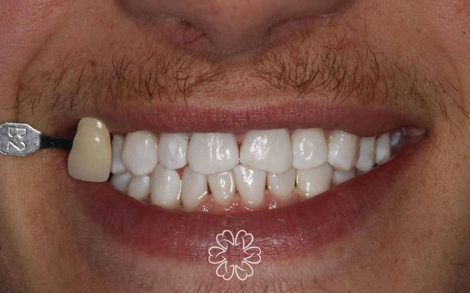 Geans Clinic - Tooth Whitening Patient After