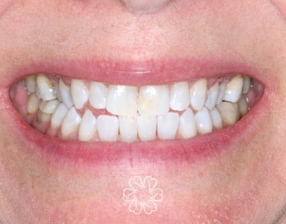Geans Clinic - Tooth Whitening Patient After