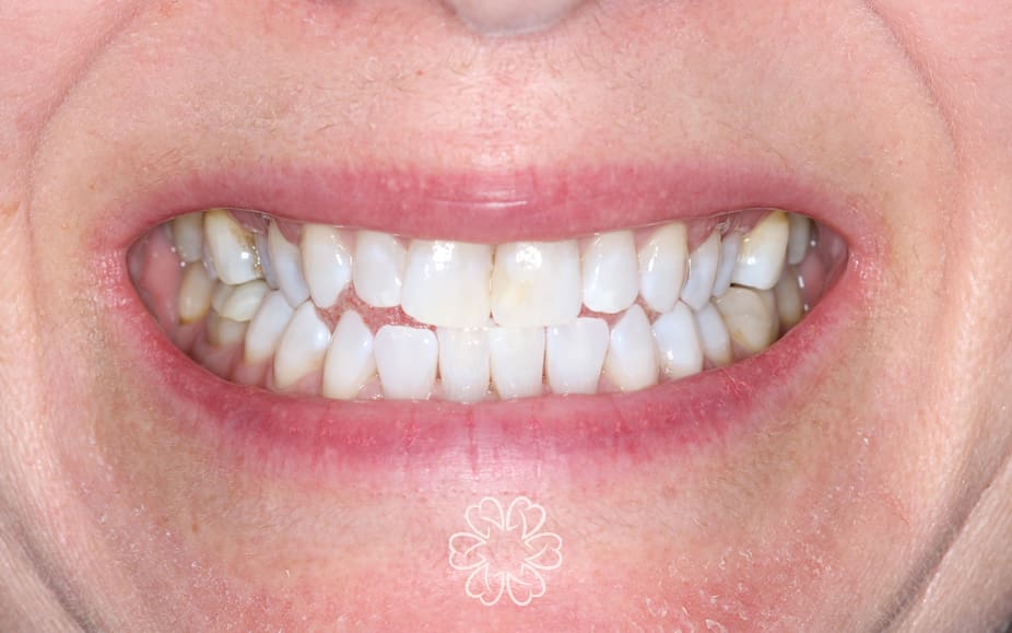Geans Clinic - Tooth Whitening Patient After