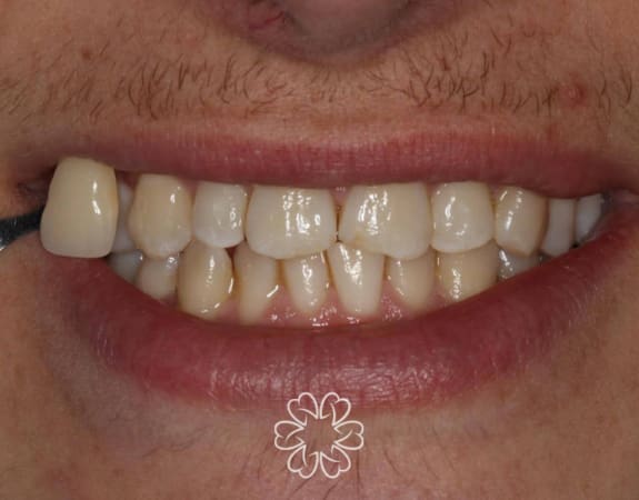 Geans Clinic - Tooth Whitening Patient Before