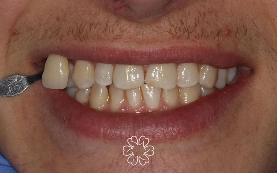 Geans Clinic - Tooth Whitening Patient Before