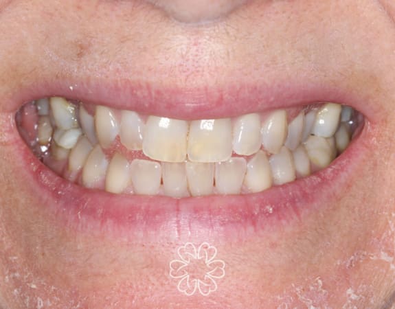 Geans Clinic - Tooth Whitening Patient Before