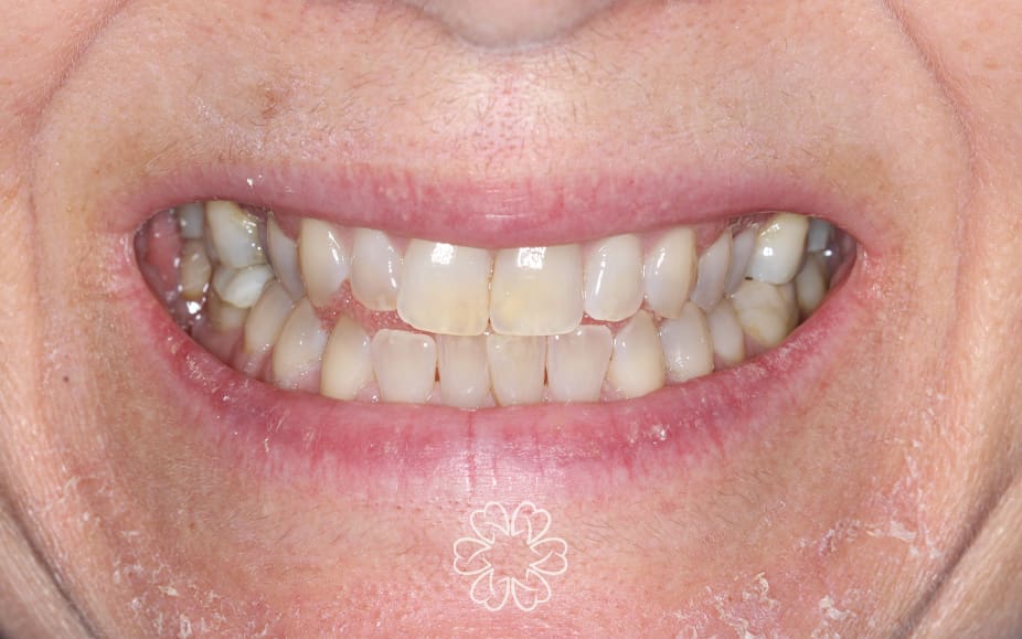 Geans Clinic - Tooth Whitening Patient Before